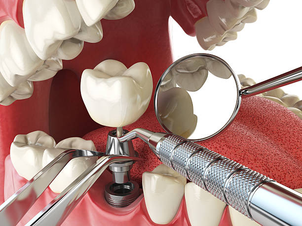 Best Dental Abscess Treatment in USA